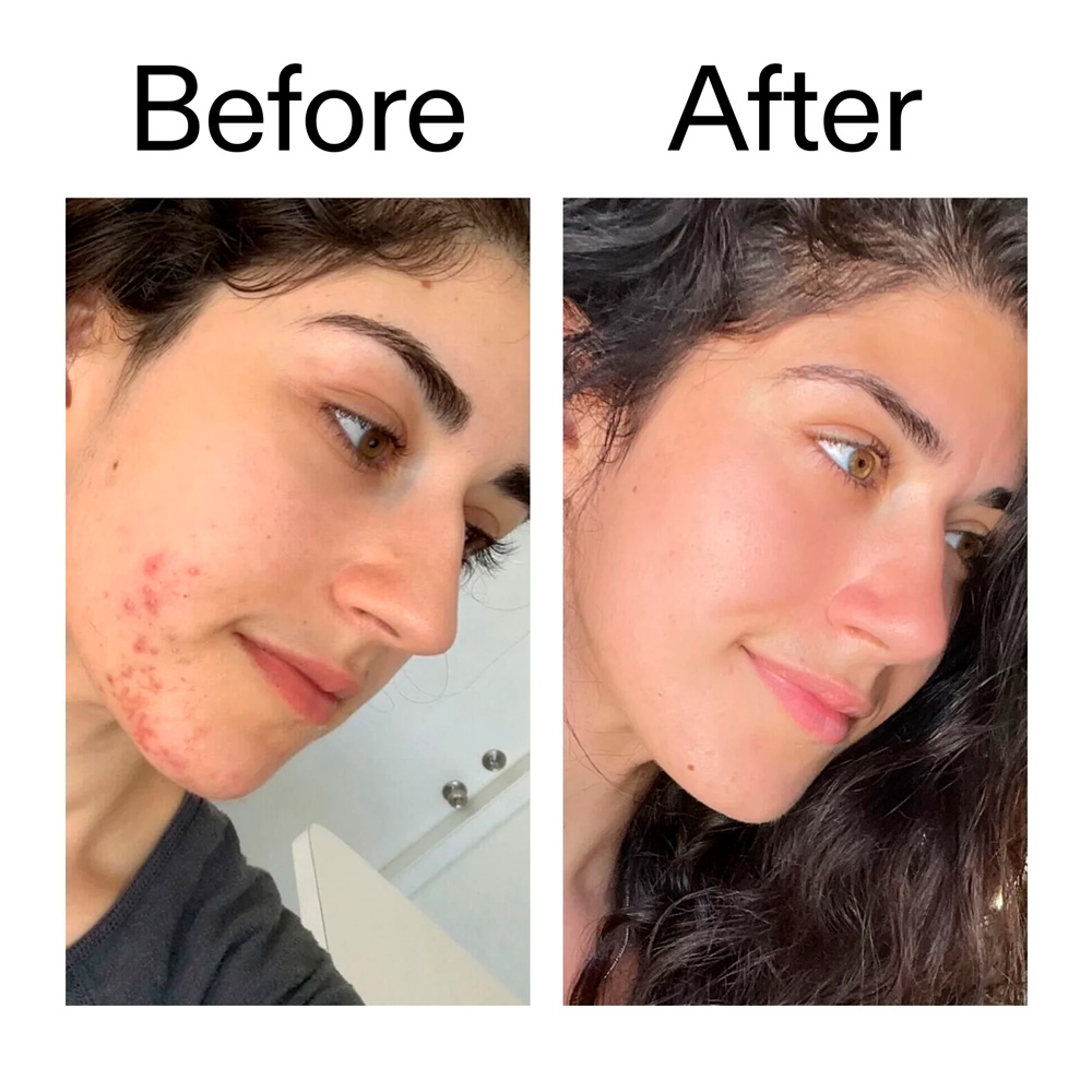 The Inkey List - Succinic Acid Acne Treatment (15ml) - Imagen 4