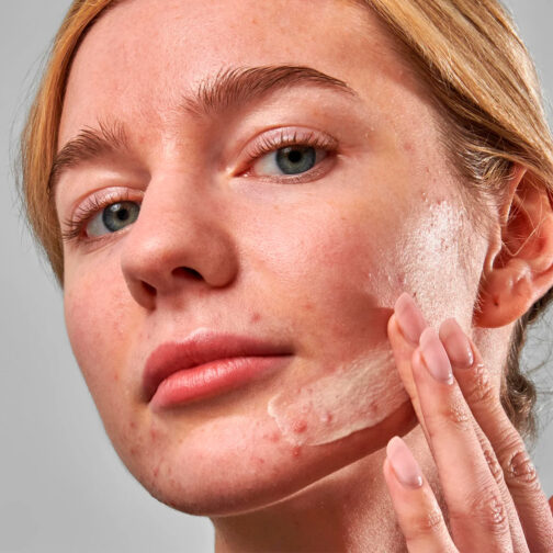 The Inkey List Acne Clearing Moisturizer - Imagen 3