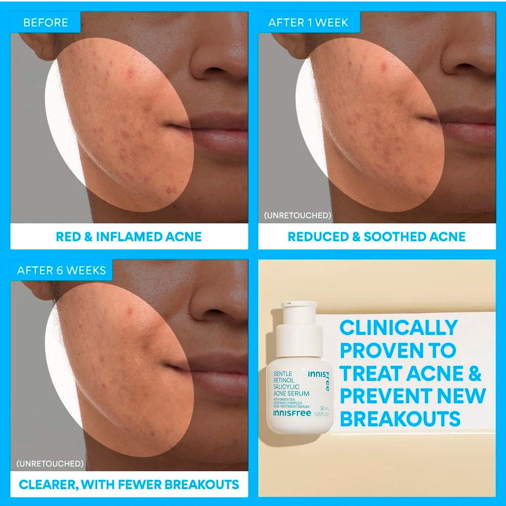 Innisfree - Gentle Retinol+Salicylic Acid Acne Serum (30ml/1.01fl.oz.) - Imagen 4