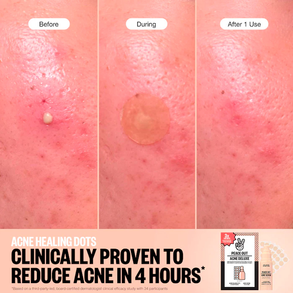 Peace Out Skincare Acne Deluxe - Imagen 3
